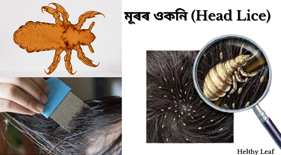 ওকনি lice